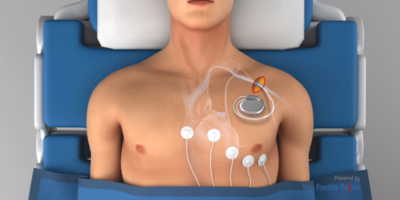 pacemaker installation